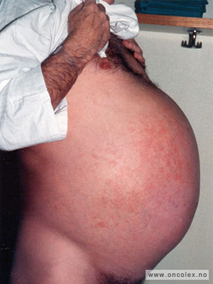 Bilde av pasient med pseudomyksom, sidebilde