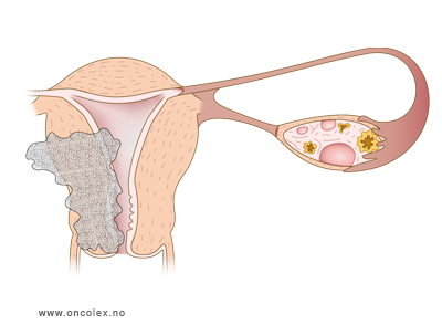 illustrasjon; Stadieinndeling kreft i livmor