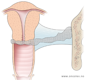 illustrasjon; Stadieinndeling kreft i livmorhals