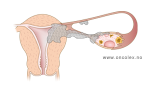 Stadieinndeling trofoblastsykdom, illustrasjon