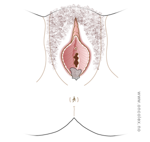 illustrasjon; Stadieinndeling kreft i kjønnsleppene