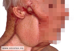 Bilde av mann som har hatt et kirurgisk inngrep på halsen