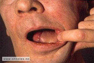 Bilde av mann som har hatt et kirurgisk inngrep på tunga.