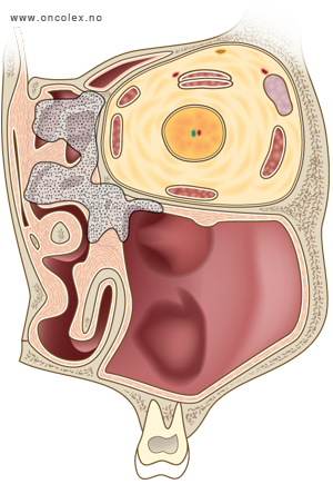 Illustrasjon, stadieinndeling kreft i munnhule