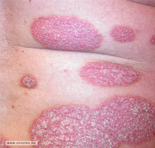 Pasient med psoriasis.