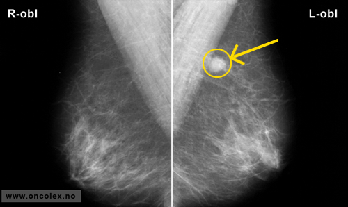 Røntgenbilde mammografi