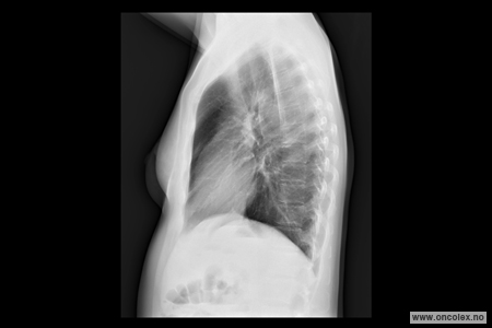 Bilde av røntgen toraks