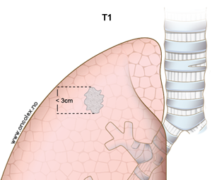Illustrasjon, stadieinndeling av lungekreft.