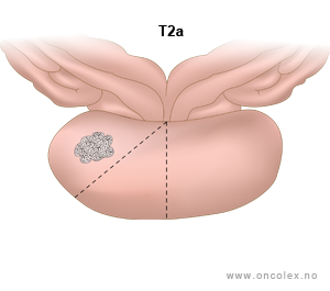 Illustrasjon, stadieinndeling av prostatakreft. T2a.