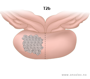Illustrasjon, stadieinndeling av prostatakreft. T2b.