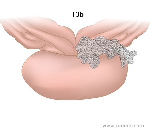 Illustrasjon, stadieinndeling av prostatakreft. T3a.