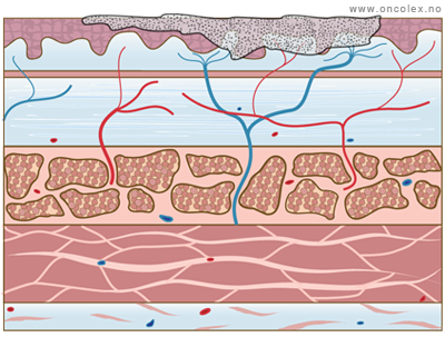 Illustrasjon, stadieinndeling av kreft i spiserør. T1.
