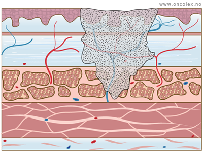 Illustrasjon, stadieinndeling av kreft i spiserør. T2.