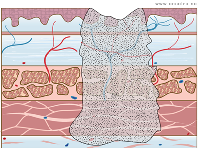 Illustrasjon, stadieinndeling av kreft i spiserør. T3.