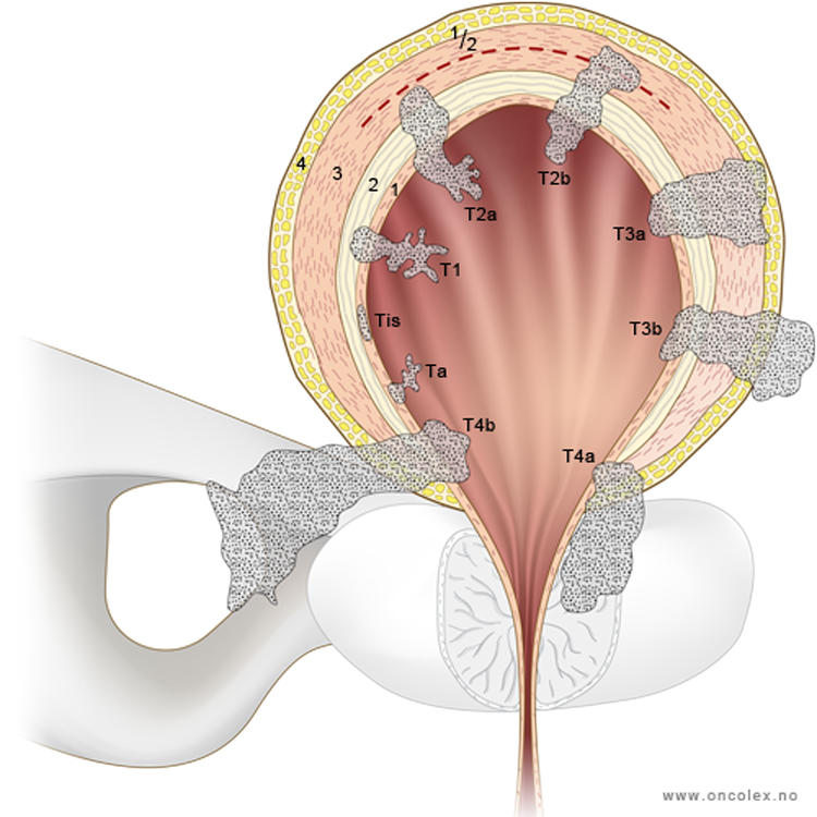 Illustrasjon stadieinndeling ved kreft i urinblæren.
