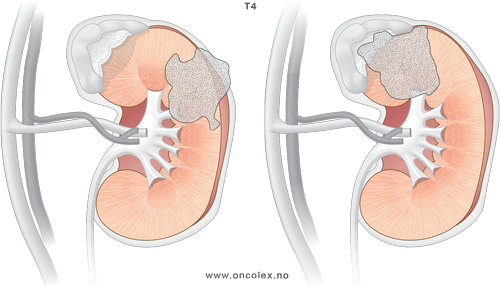 Illustrasjon, stadieinndeling ved kreft i nyrene. T4.