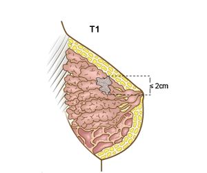 Brystkreft. Svulst under 2 cm i største diameter
