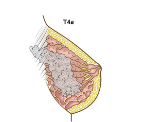 Brystkreft, stadie T4a