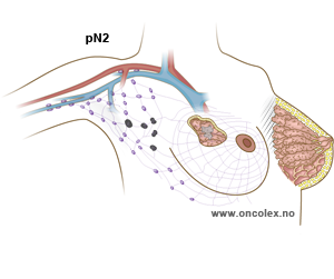 Brystkreft, stadie N2