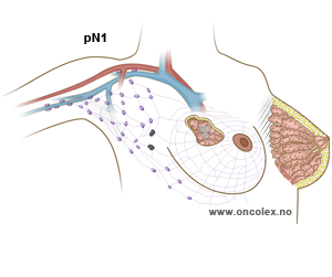 Brystkreft, stadie N1