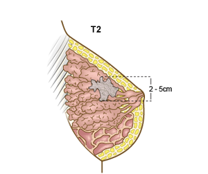 Brystkreft, stadie T2