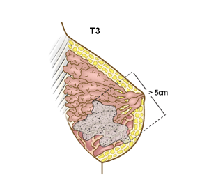 Brystkreft, stadie T3