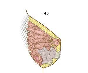 Brystkreft, stadie T4b