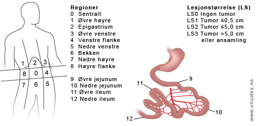 Illustrasjon over regioner og score til bruk ved utregning av Peritoneal Carcinomatosis Index (PCI).