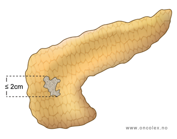 Illustrasjon stadie pT1 bukspyttkjertelkreft
