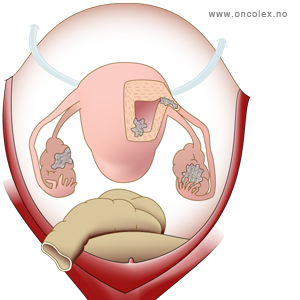 illustrasjon; Stadieinndeling kreft i eggstokk/eggleder