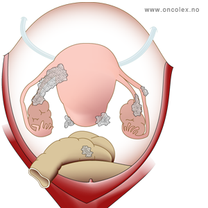 illustrasjon; Stadieinndeling kreft i eggstokk/eggleder