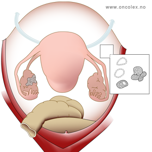 illustrasjon; Stadieinndeling kreft i eggstokk/eggleder