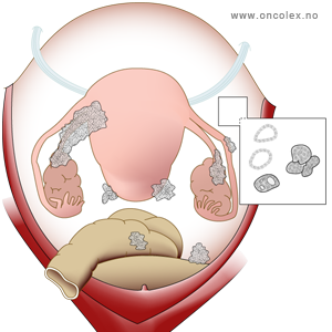 illustrasjon; Stadieinndeling kreft i eggstokk/eggleder