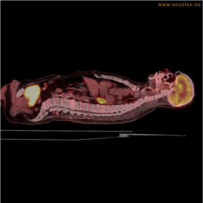 Resultat av PET-undersøkelse, utredning av kreft. Kreftsvulst i spiserør.