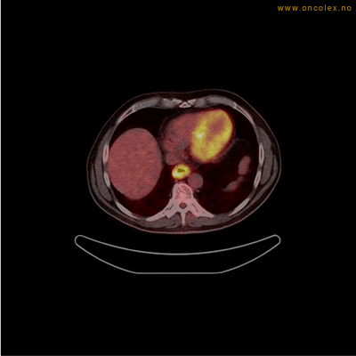 Resultat av PET-undersøkelse, utredning av kreft.