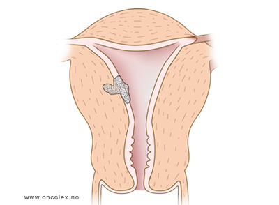 illustrasjon; Stadieinndeling kreft i livmor