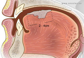Illustrasjon, stadieinndeling kreft i munnhule