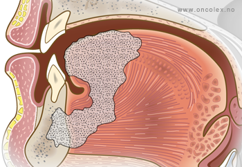 Illustrasjon, stadieinndeling kreft i munnhule