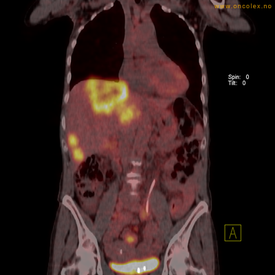 Resultat av PET-undersøkelse, utredning av kreft.