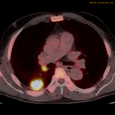 Resultat av PET-undersøkelse, utredning av kreft.