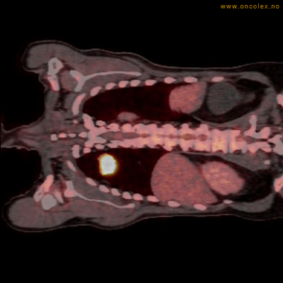 Resultat av PET-undersøkelse, utredning av kreft.