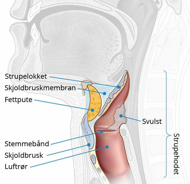 Kreft i strupehode, stadieinndeling.