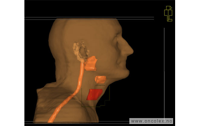 Kreft i strupehode, strålebehandling.