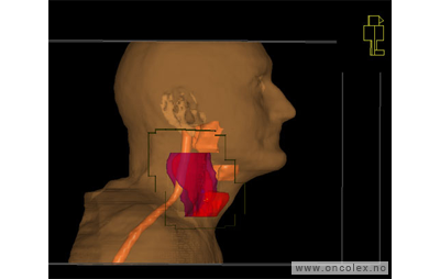 Kreft i strupehode, strålebehandling.