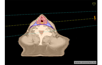 Kreft i strupehode, strålebehandling.