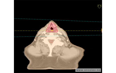 Kreft i strupehode, strålebehandling.
