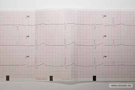 Resultat av EKG