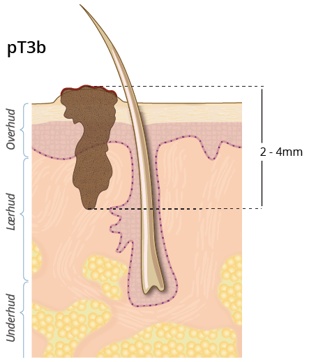 ©kreftlex.no, melanoma, føflekkreft, stadie, pT3b