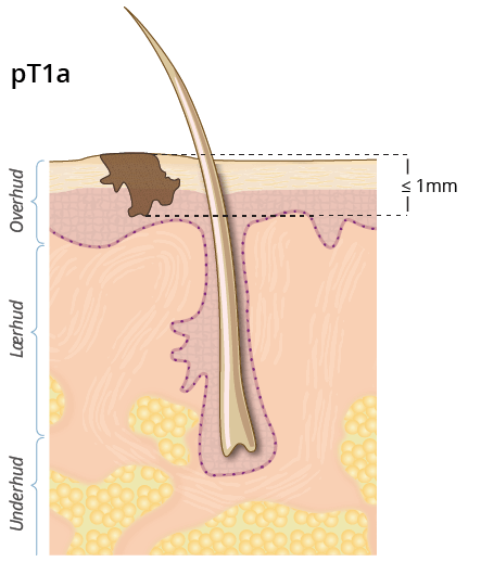 ©kreftlex.no, melanoma, føflekkreft, stadie, pT1a