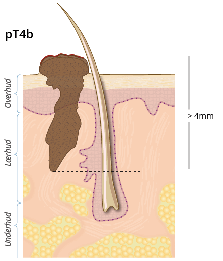 ©kreftlex.no, melanoma, føflekkreft, stadie, pT4b